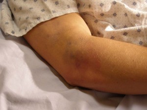 Street Warrior arm bruise